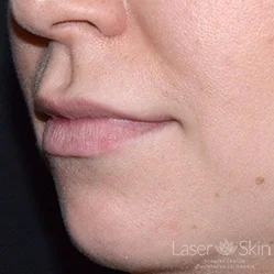 Pre Juvederm Volbella treatment