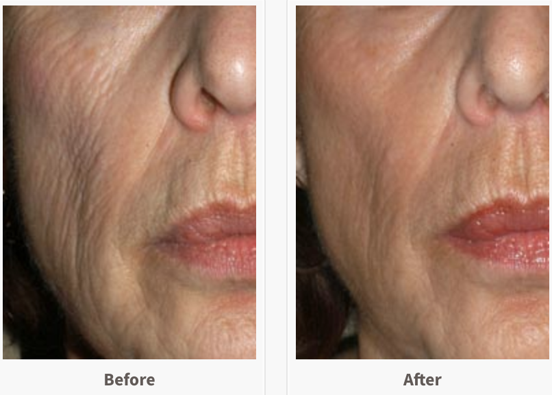 Fractional Ablative Laser.png