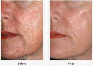 Fractal Non-Ablative Laser Before and After.png