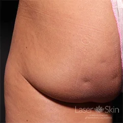 Pre Cellfina treatment for cellulite