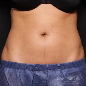 12 weeks after two truSculpt iD treatments
