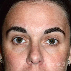 Post multiple Clear + Brilliant Permea Laser treatments