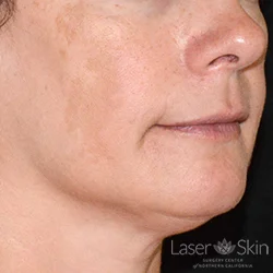 Pre Clear + Brilliant Permea Laser