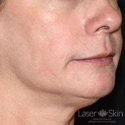 Pre Clear + Brilliant Permea Laser