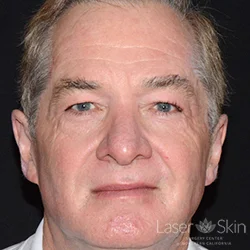 3 months Post CO2 Laser Resurfacing
