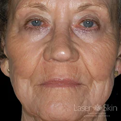 1 year Post CO2 Laser Resurfacing