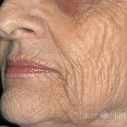 Pre CO2 Laser Resurfacing