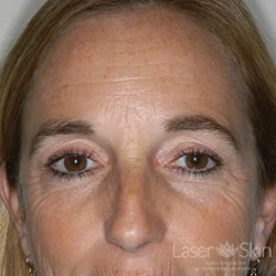 Pre CO2 Laser Resurfacing