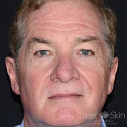 Pre CO2 Laser Resurfacing