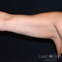 3 months post 1 CoolSculpting treatment for upper arms