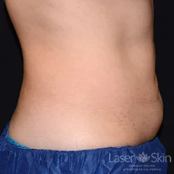 4 months post CoolSculpting treatments to the abdomen