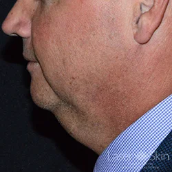 Pre CoolSculpting Coolmini treatments to the submental (double chin) area