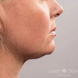 Post 2 CoolSculpting Coolmini treatments to the submental (double chin) area