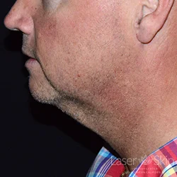 Post 2 CoolSculpting Coolmini treatments to the submental (double chin) area