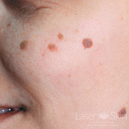 Pre LP Alex Laser to Seborrheic Keratoses
