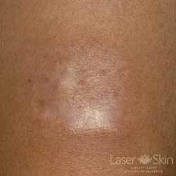 Post multiple laser treatments to scar