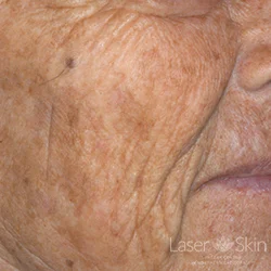 1 month post QS Alex Laser to Brown Spots
