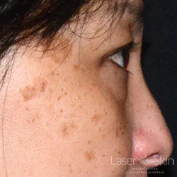 Pre QS Alex Laser to Brown Spots