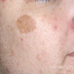 Pre QS Alex Laser to Brown Spots