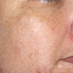 Post QS Alex Laser to Brown Spots