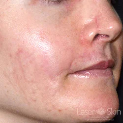 5 weeks post 1 VBeam Laser treatment to red scars