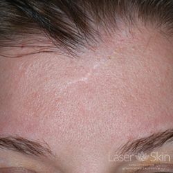 Post multiple VBeam and Fraxel Restore Laser treatments to scars