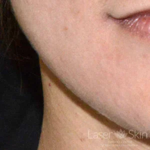 4 months post Hyaluronic Acid Filler for depressed scar on patient’s chin
