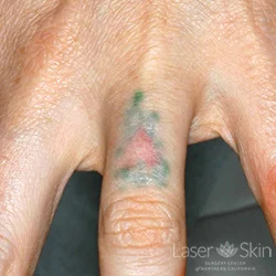 Pre Laser Tattoo Removal