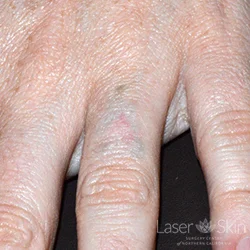 Post multiple Q-switched Nd:YAG and Picosecond Laser treatments to tattoo