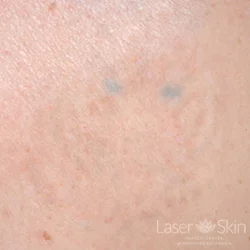 Post 16 Q-switched Nd:YAG Laser treatments to tattoo