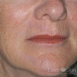 Post multiple Q-switched Nd:YAG and VBeam Laser treatments to Traumatic Tattoo