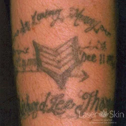 Pre Laser Tattoo Removal