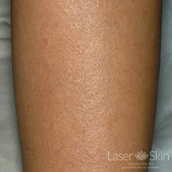Post 14 Q-switched Nd:YAG Laser treatments to tattoo