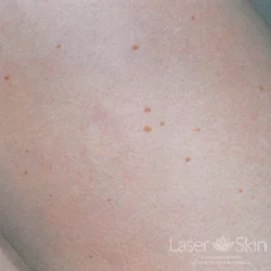 Post 9 Q-switched Nd:YAG Laser treatments to tattoo