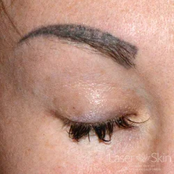 Pre Laser Tattoo Removal