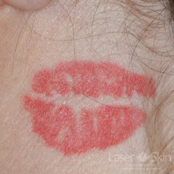 Pre Laser Tattoo Removal