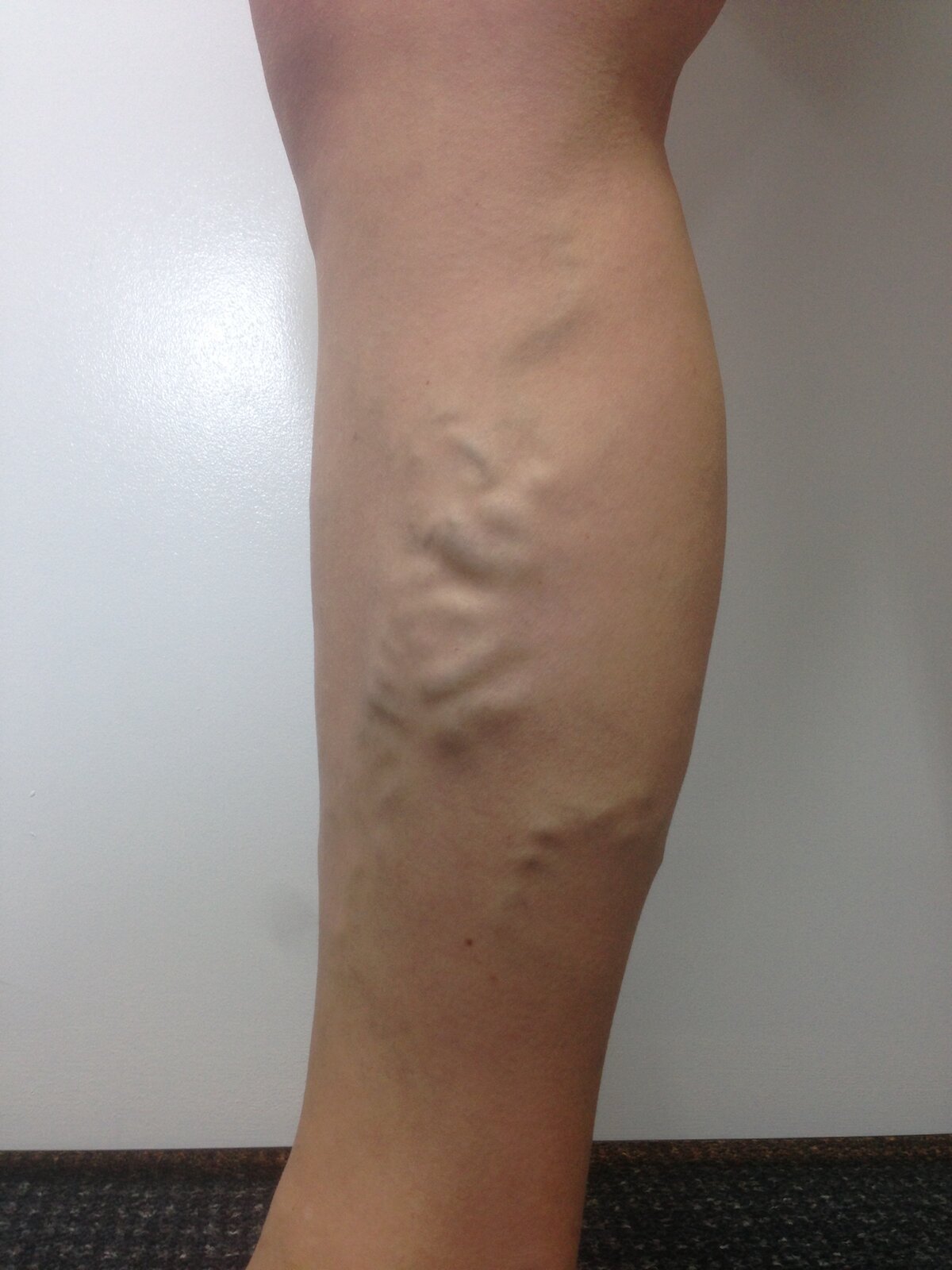 Varicose Vein Results and post treatment photos. — The Leg Vein Doctor