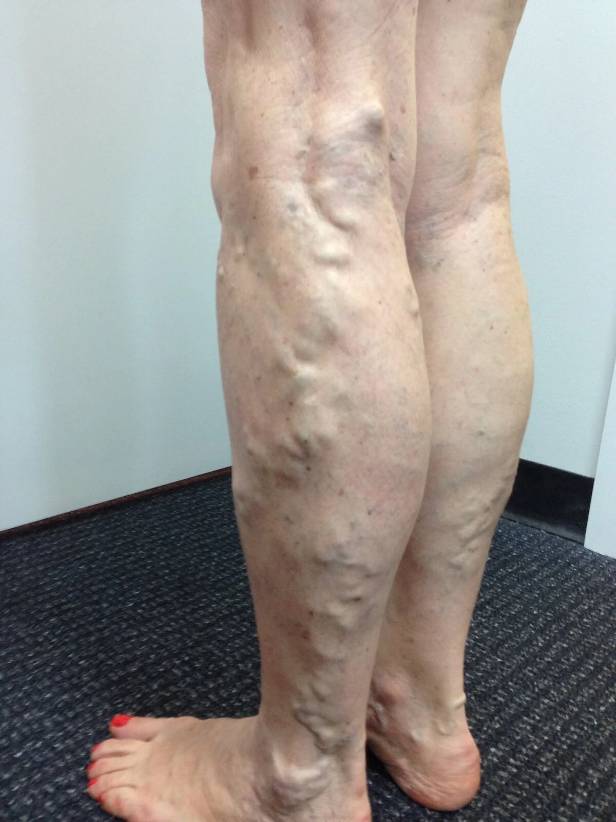 Varicose Vein Results and post treatment photos. — The Leg Vein Doctor