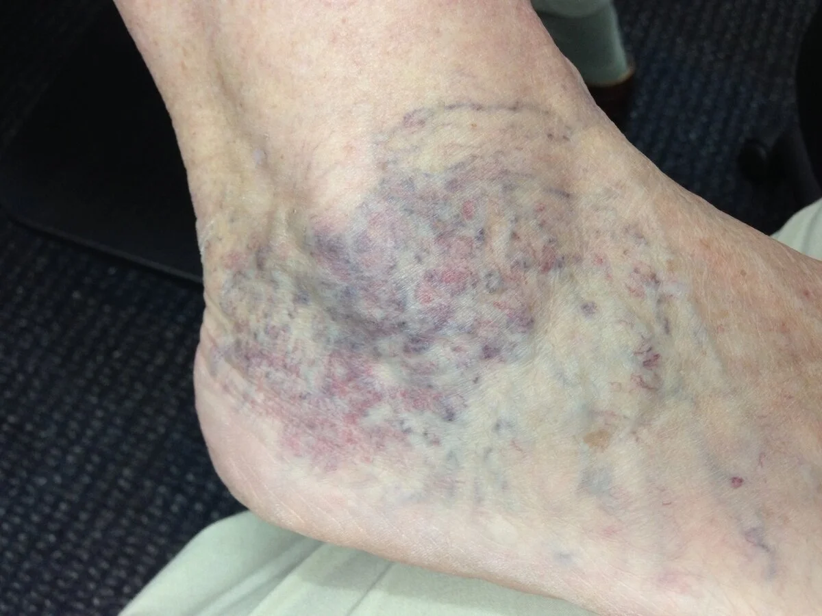 spider-vein-treatment-brisbane-results-the-leg-vein-doctor-brisbane