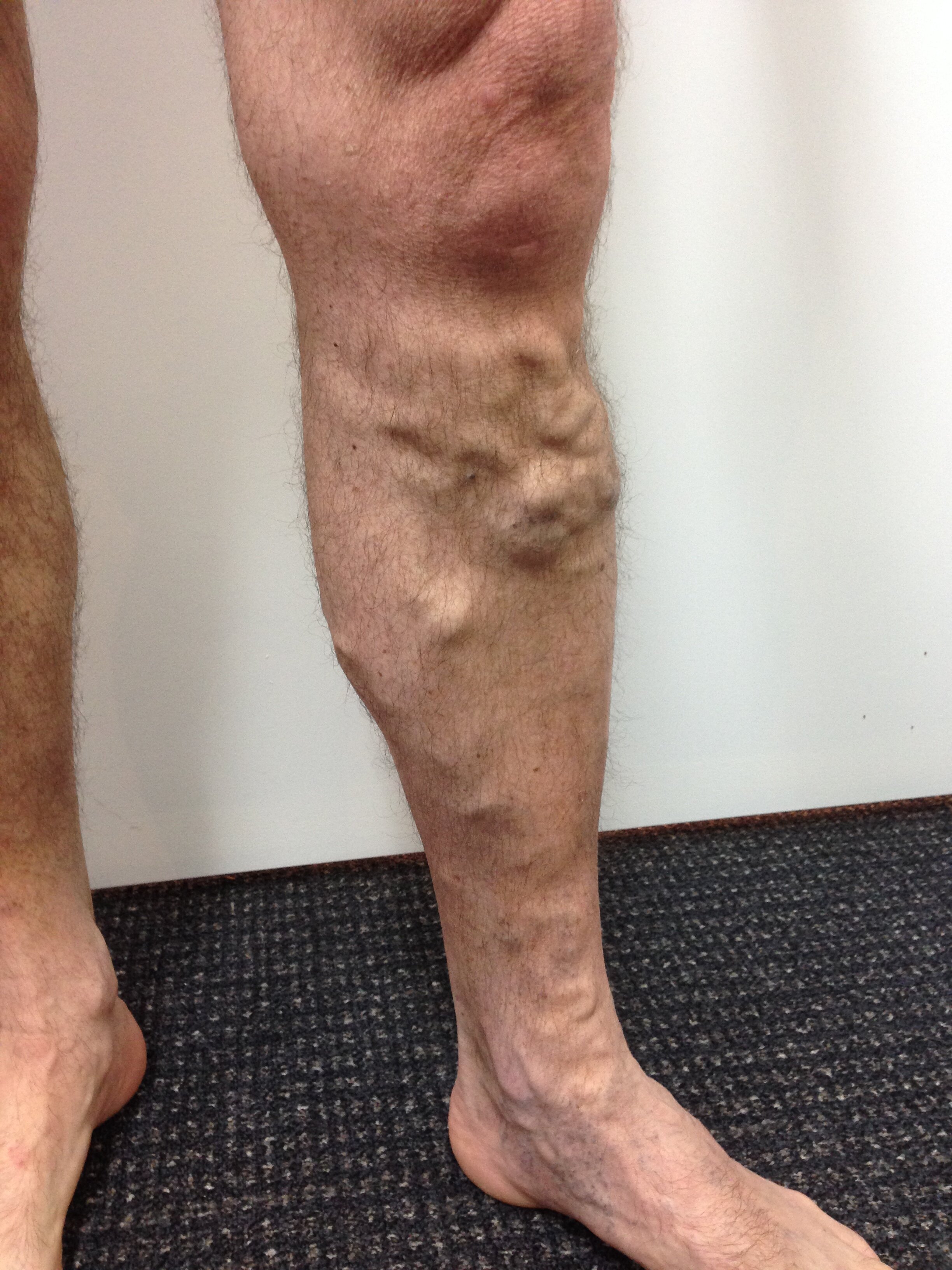 What are Spider Veins? — The Leg Vein Doctor, Brisbane
