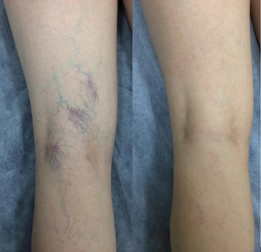 Microsclerotherapy — The Leg Vein Doctor Brisbane Varicose And
