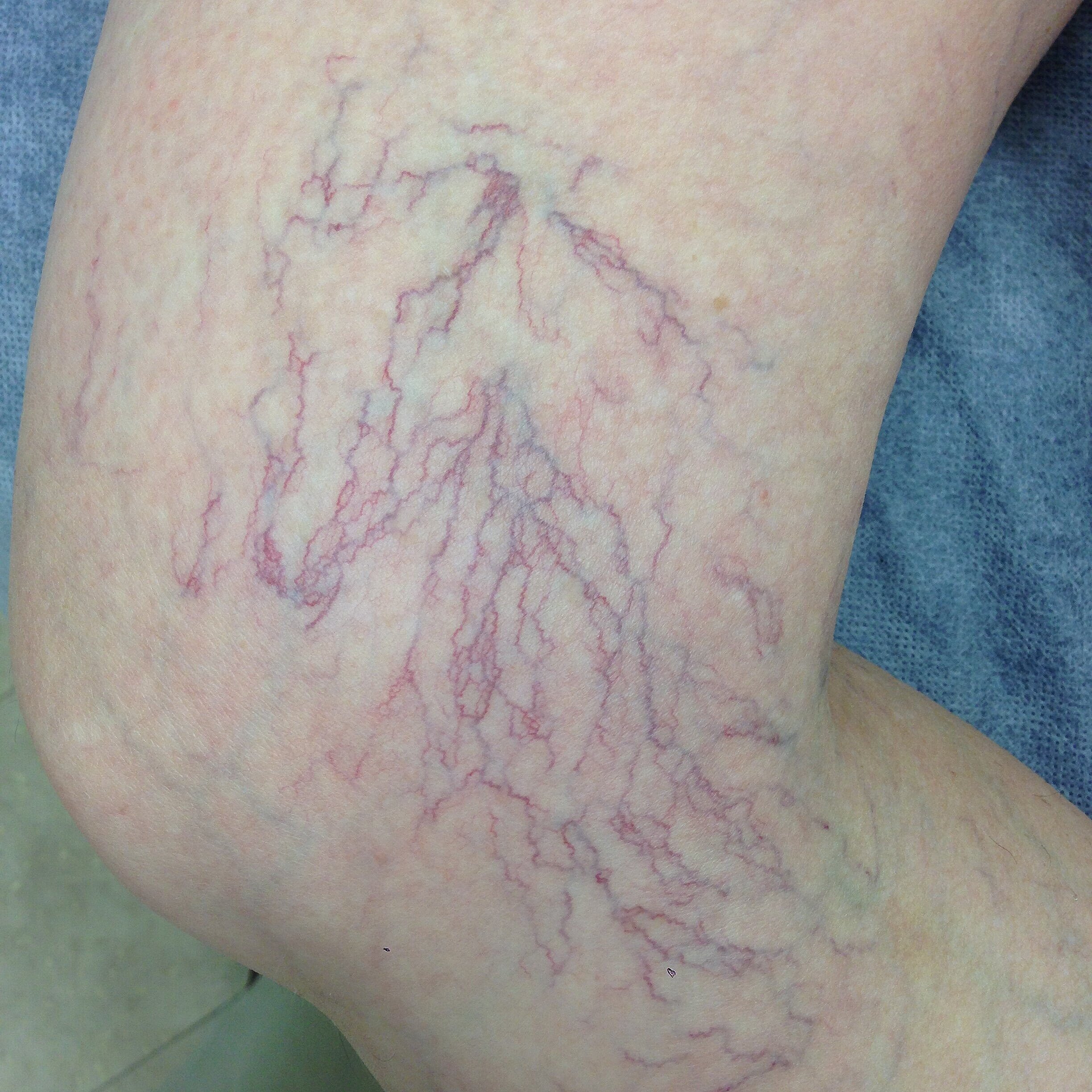 What Are Spider Veins — The Leg Vein Doctor Brisbane Varicose And