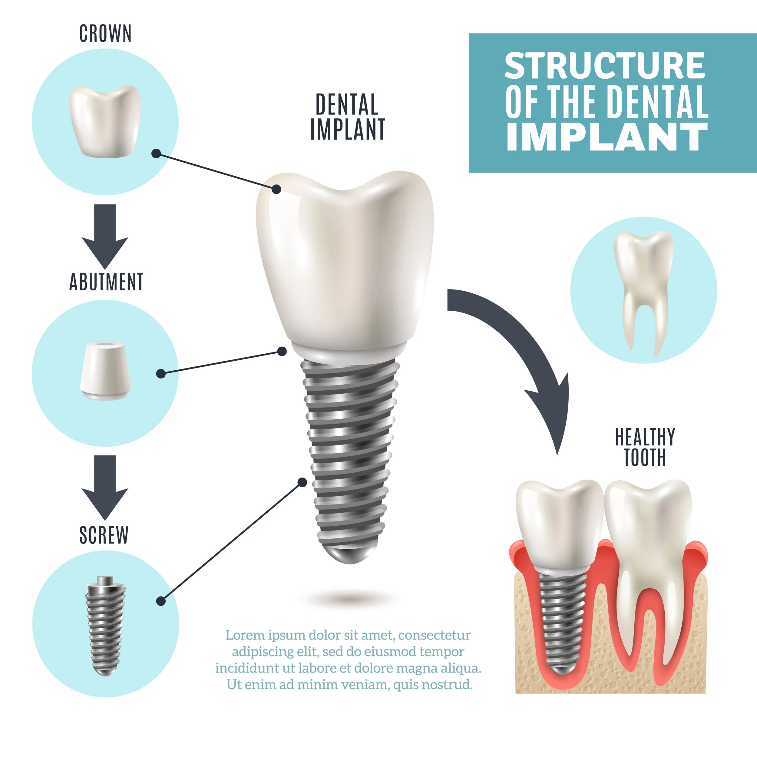 StructureofDentalImplantInfographic.jpg