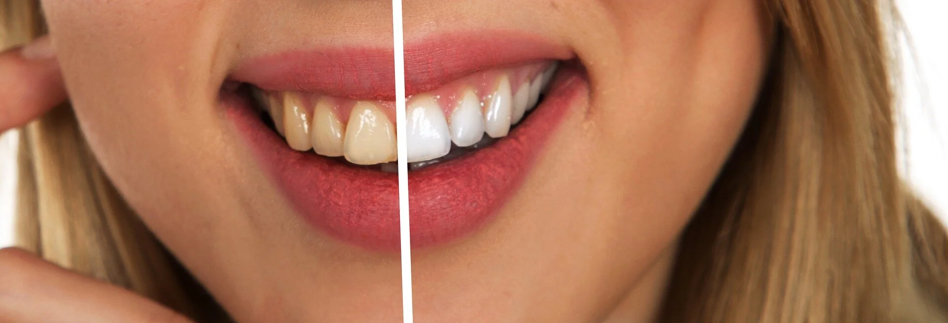 Want Whiter Teeth?