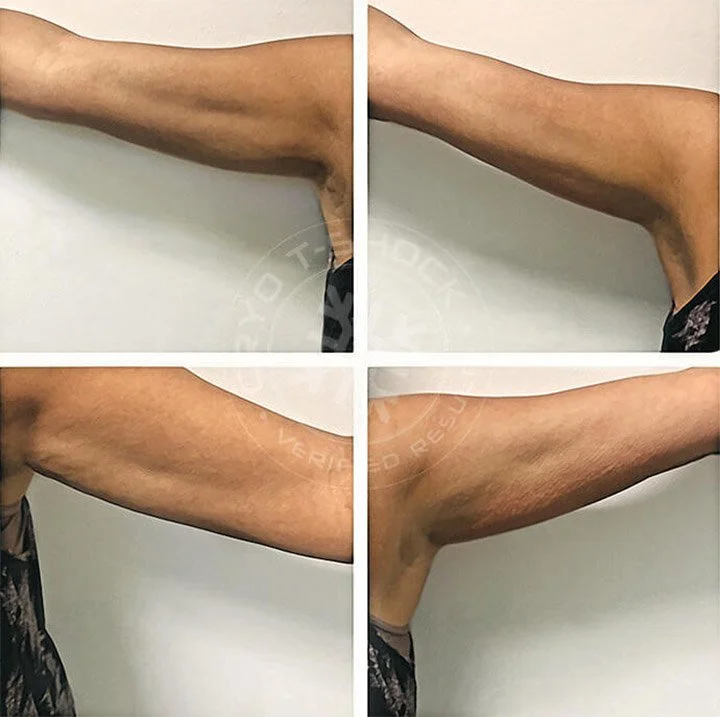 CoolSculpting For The Arms — SKIN SCIENCE SOLUTIONS