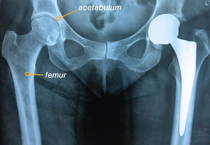  Hip Arthroscopy  Hip Osteotomies  Hip Replacement – Anterior Minimally Invasive  Hip Replacement Revision 
