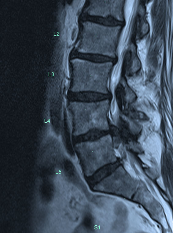  Spine Microdiscectomy  Spine Laminectomy  Spine Anterior Cervical Decompression And Fusion  Spine Anterior Lumbar Decompression And Fusion  Spine Posterior Lumbar Decompression And Fusion  Spine Extreme Lateral Lumbar  Decompression and Fusion  Coccygectomy 
