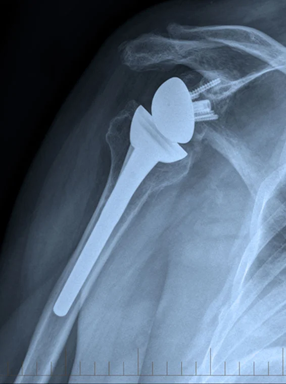  Shoulder Arthroscopic and Open Stabilisation for Recurrent Dislocation  Shoulder Arthroscopic Bursectomy,  Decompression and Rotator Cuff Repair  Shoulder Arthroscopic SLAP Tear  Repair/ Biceps Tenodesis  Shoulder Replacement Anatomic and Reverse 