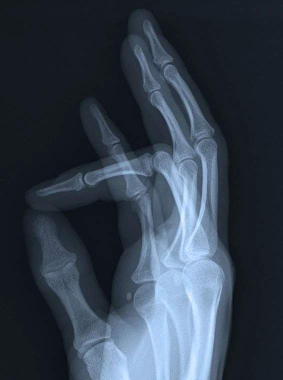  Carpal Tunnel Release  Ulnar Nerve Decompression and Transposition  Trigger Finger Release  Dupuytren’s Contracture Release  Tennis and Golfers Elbow Tendon Repair  Wrist Arthroscopy  Wrist Ligament Reconstruction  Wrist Fusion (Partial and Total)  Osteotomies for Malunited Fractures  Surgery for Thumb Base Arthritis  Surgery for Finger Joint Arthritis 