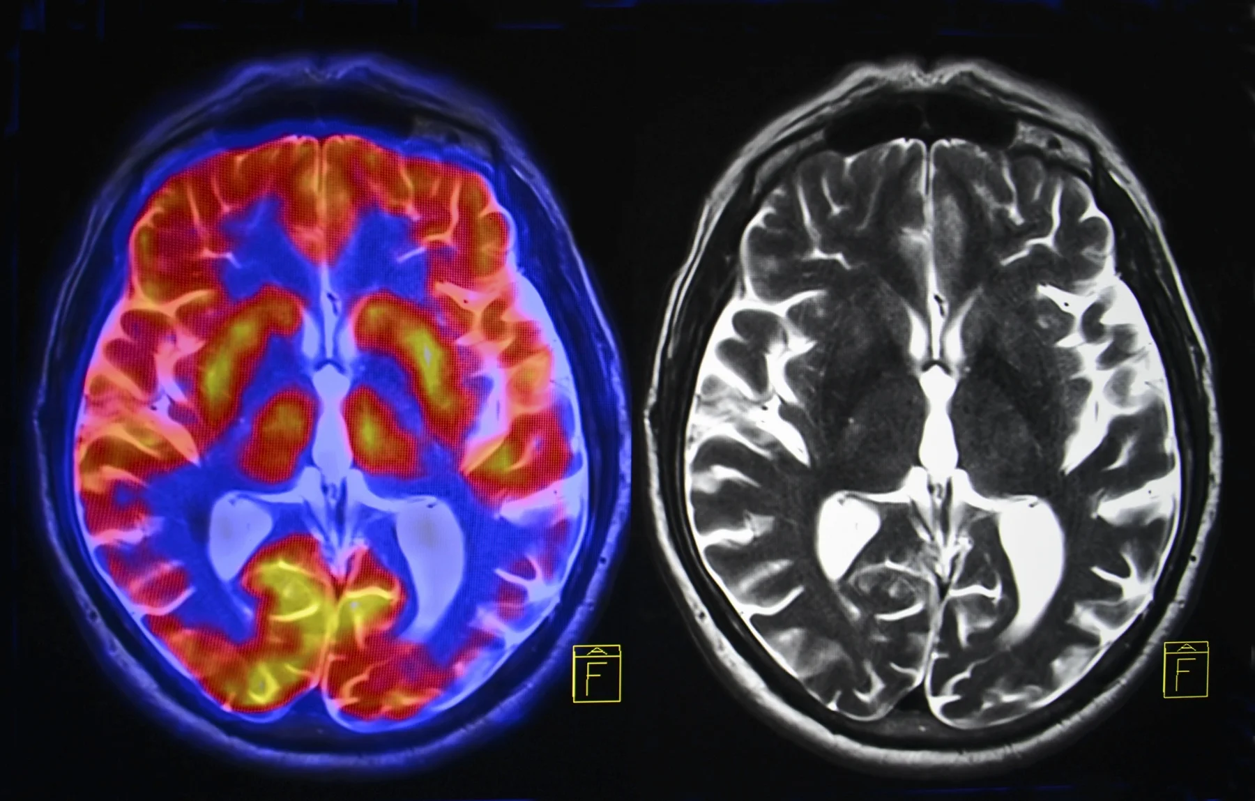 Brain-psychological-injury.jpg